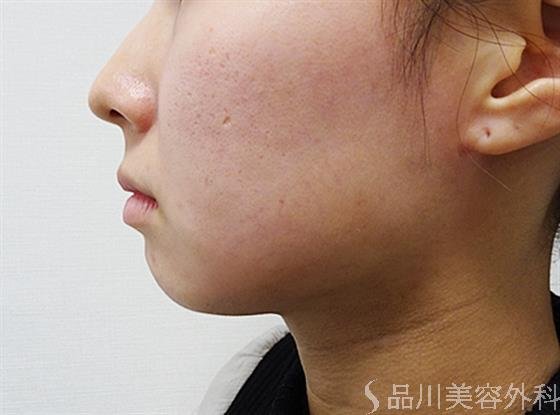 症例NO.53255のBEFORE写真