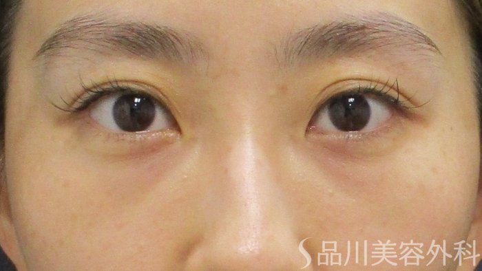 症例NO.73243のAFTER写真