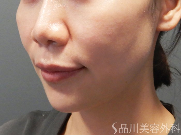 症例NO.70425のBEFORE写真