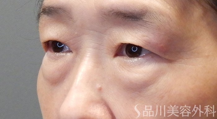 症例NO.70528のBEFORE写真
