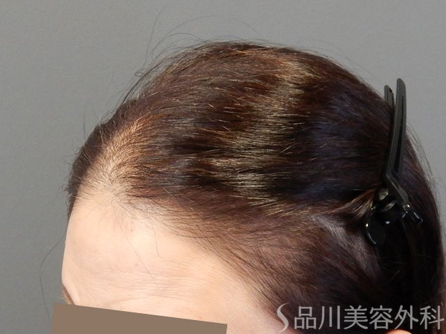 症例NO.70455のBEFORE写真