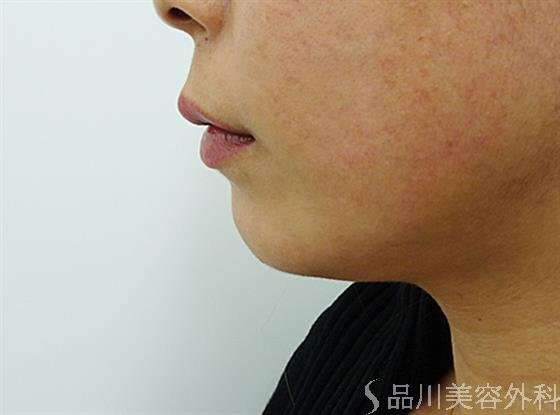 症例NO.44630のBEFORE写真