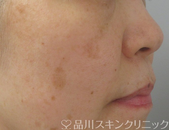 症例NO.72869のBEFORE写真