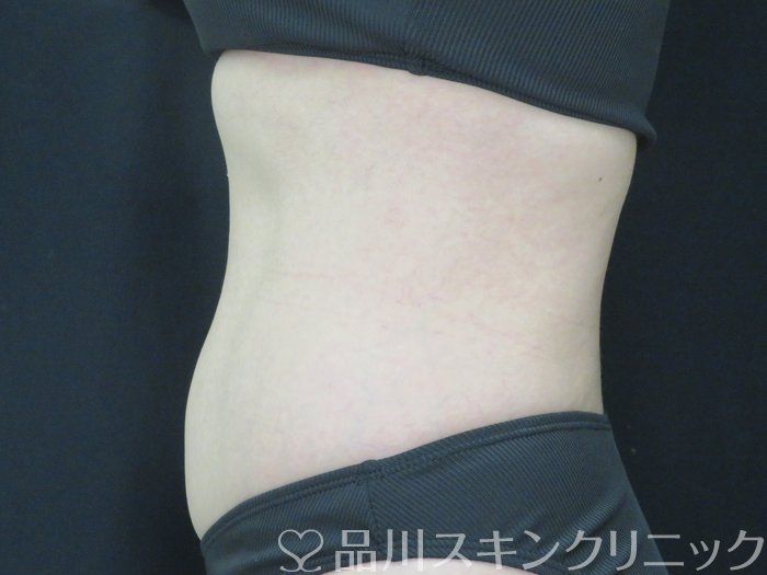 症例NO.70144のAFTER写真
