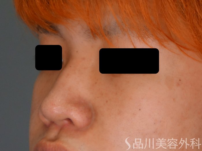 症例NO.75050のBEFORE写真