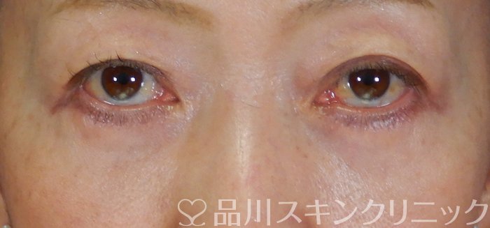 症例NO.64226のAFTER写真