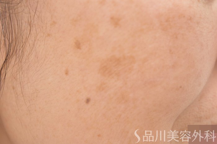 症例NO.64702のBEFORE写真