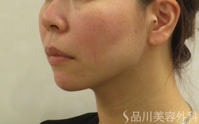 症例NO.62363のBEFORE写真