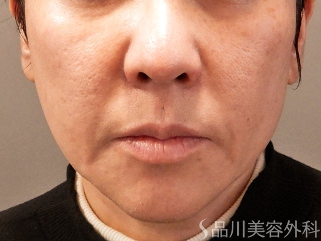症例NO.69756のBEFORE写真