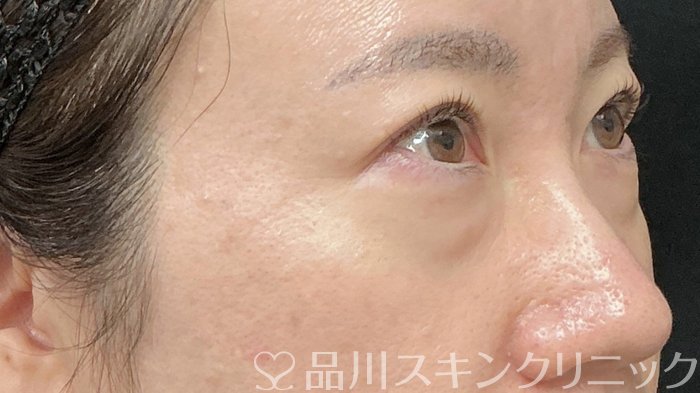 症例NO.74592のBEFORE写真