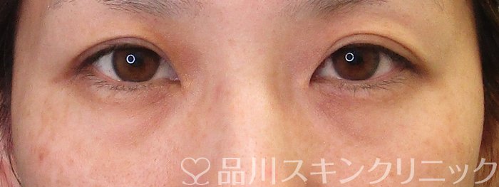 症例NO.64055のBEFORE写真
