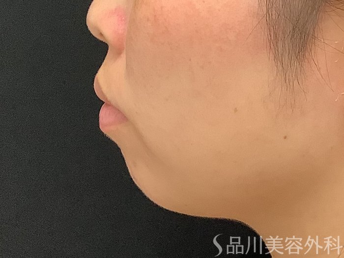 症例NO.67893のBEFORE写真