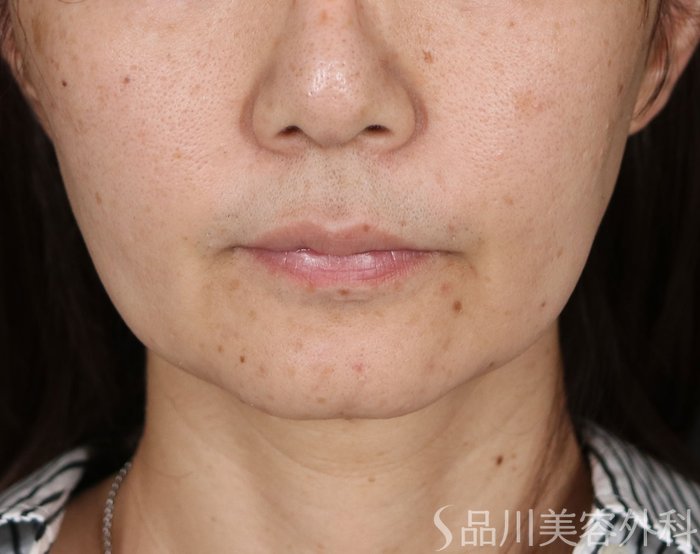 症例NO.71665のBEFORE写真