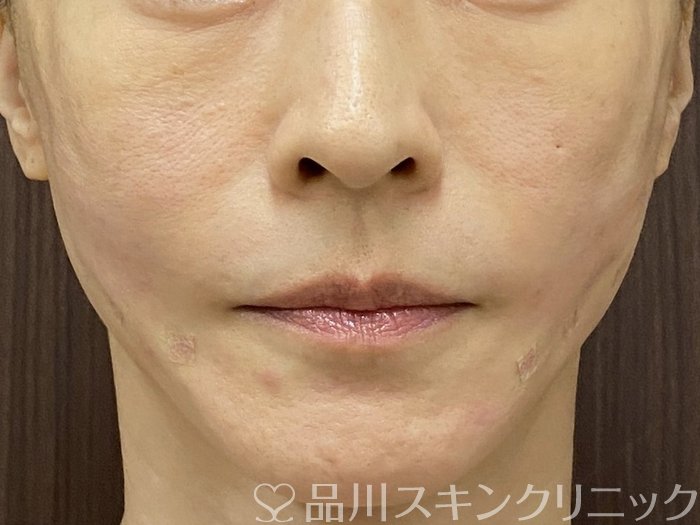 症例NO.74597のAFTER写真