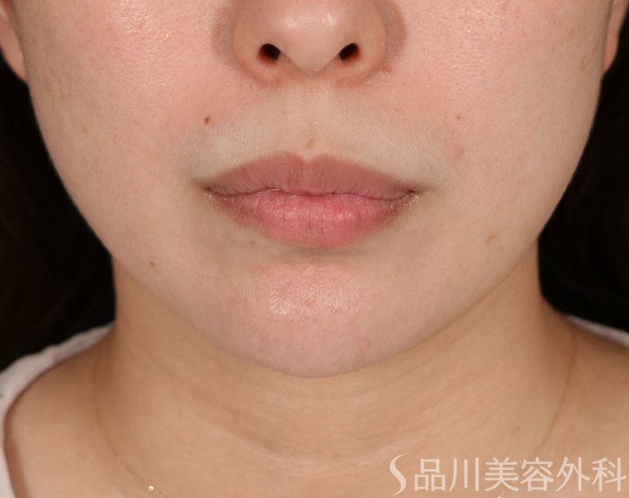 症例NO.71682のBEFORE写真