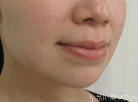症例NO.55131のBEFORE写真