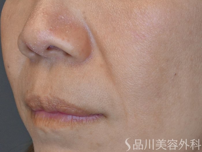 症例NO.69507のBEFORE写真
