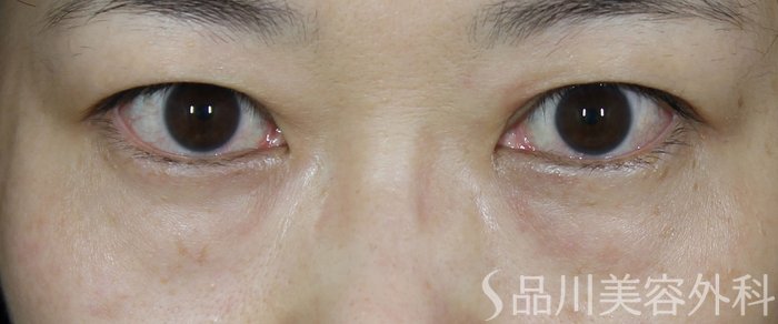 症例NO.72254のBEFORE写真