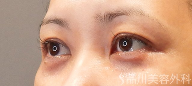 症例NO.71713のAFTER写真
