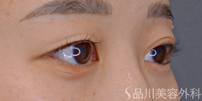症例NO.73792のBEFORE写真