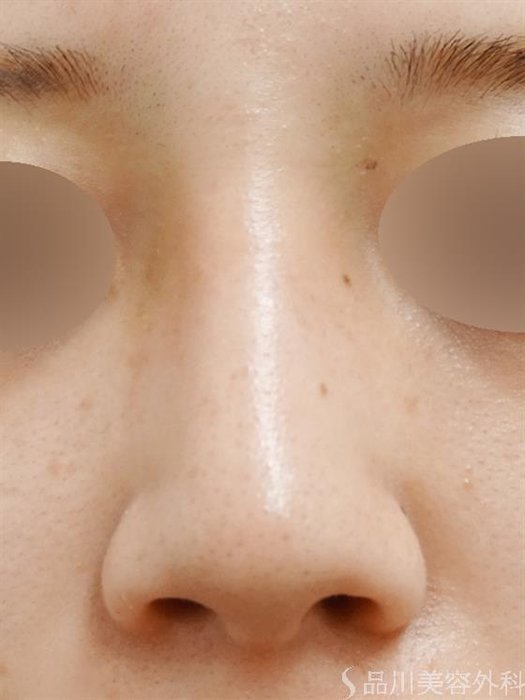 症例NO.43849のAFTER写真