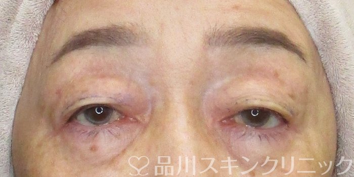 症例NO.75150のBEFORE写真