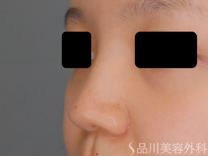 症例NO.70911のBEFORE写真