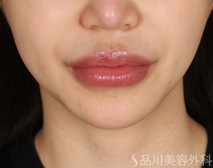 症例NO.73455のBEFORE写真