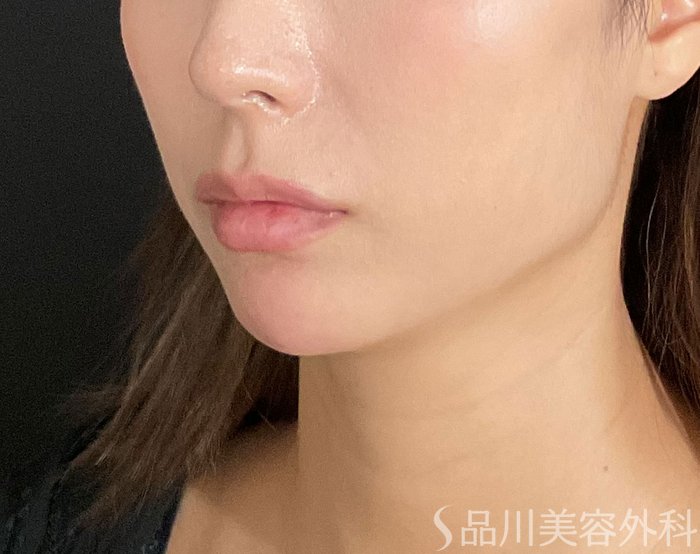 症例NO.74507のAFTER写真