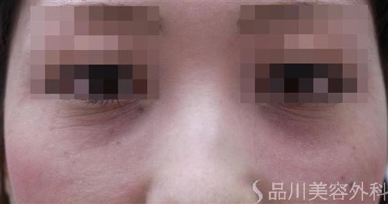 症例NO.19296のBEFORE写真