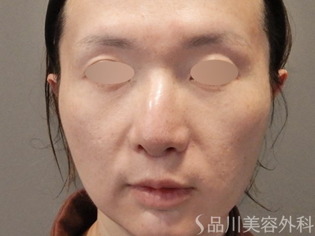 症例NO.74574のAFTER写真