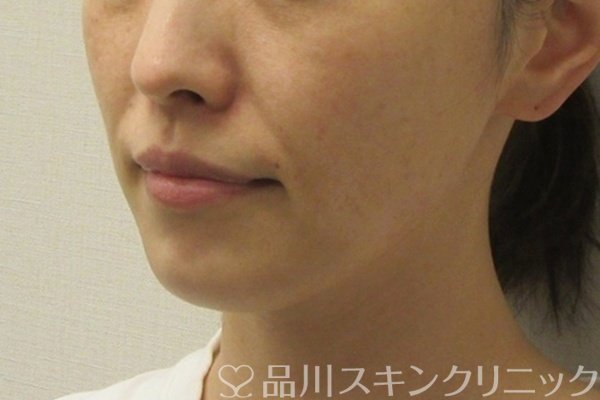 症例NO.74647のBEFORE写真