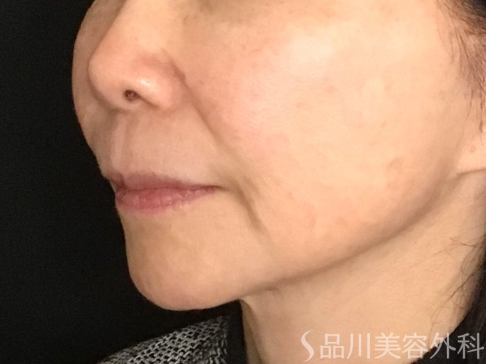 症例NO.65312のBEFORE写真