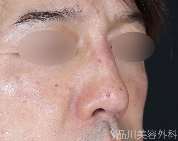 症例NO.72309のAFTER写真