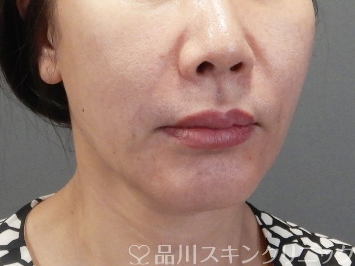 症例NO.75178のBEFORE写真