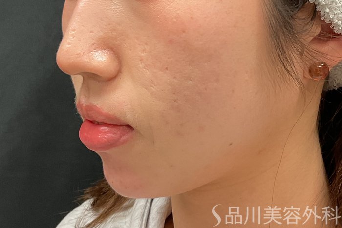 症例NO.73323のAFTER写真