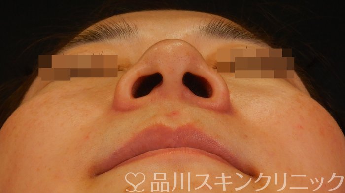 症例NO.66808のBEFORE写真