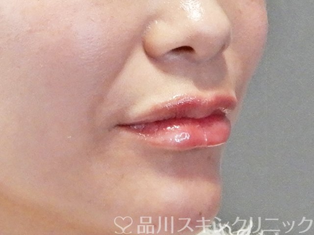 症例NO.67708のAFTER写真