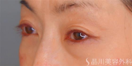 症例NO.55177のBEFORE写真