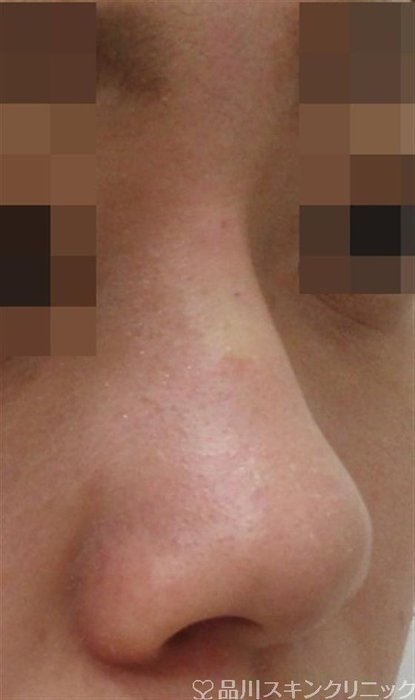症例NO.42154のAFTER写真