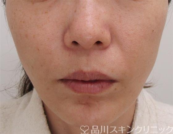 症例NO.43048のAFTER写真