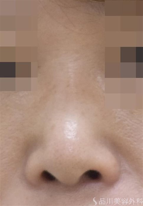 症例NO.50010のBEFORE写真