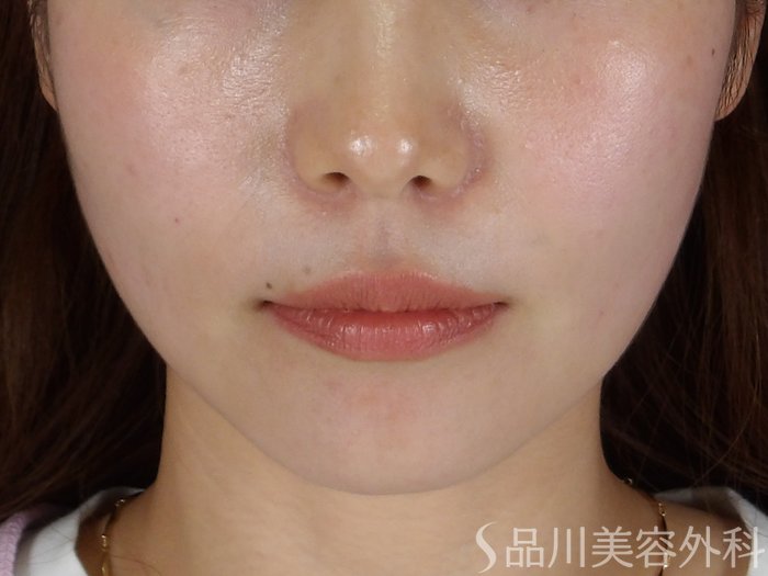 症例NO.71209のAFTER写真