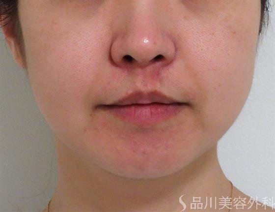 症例NO.39985のBEFORE写真
