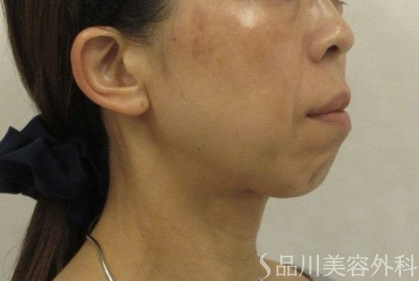 症例NO.74858のBEFORE写真