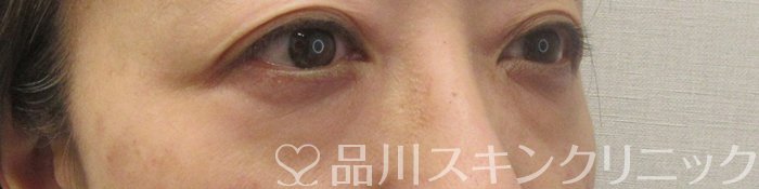 症例NO.71049のBEFORE写真
