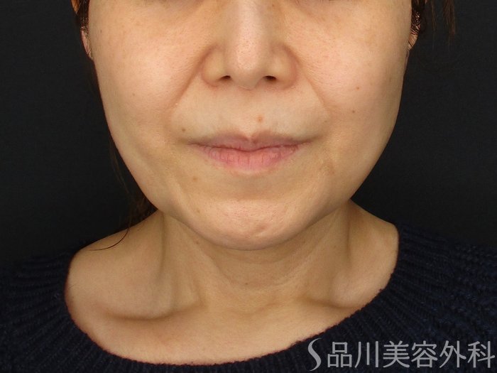 症例NO.69538のBEFORE写真