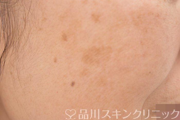 症例NO.64702のBEFORE写真