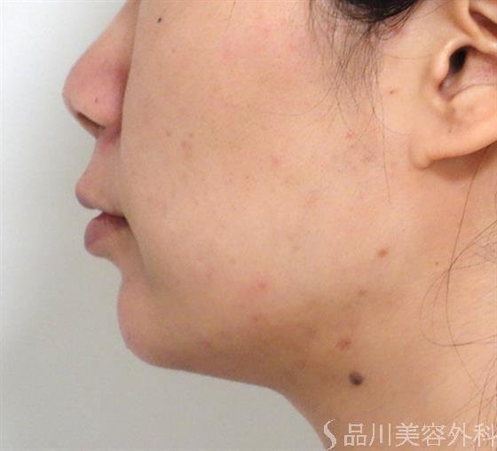 症例NO.35168のBEFORE写真