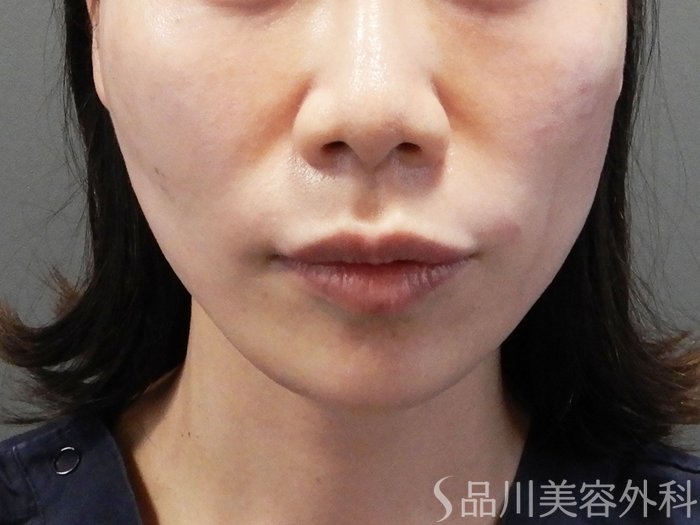 症例NO.70425のAFTER写真